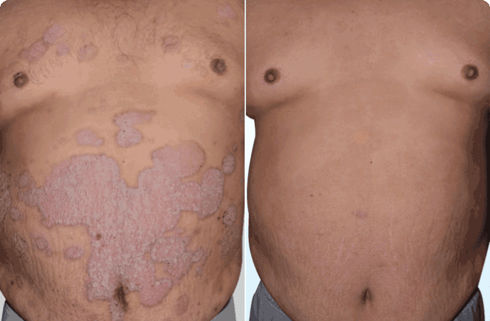 Case 1: Psoriasis 
After Treatment (3–6 Months): Cellular Therapy and Stem Cells for Dermatology and Skin Conditions at DrStemCellsThailand's Anti-Aging and Regenerative Medicine Center of Thailand showed remarkable results, including significant reduction in plaque thickness, scaling, and redness. Over 70% of treated patients exhibited a Psoriasis Area and Severity Index (PASI) improvement by over 75%, indicating near-complete clearance of lesions.