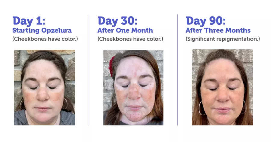 Case 2: Vitiligo
Before Treatment: Patients presented with extensive areas of depigmentation, particularly around the face, hands, and joints, creating a patchy and uneven skin tone.

After Treatment (4–8 Months): Post-treatment of Cellular Therapy and Stem Cells for Dermatology and Skin Conditions at DrStemCellsThailand's Anti-Aging and Regenerative Medicine Center of Thailand observations revealed repigmentation in 60–70% of affected areas, with melanocyte restoration evident in the perifollicular zones. Results also demonstrated gradual merging of repigmented regions, providing a more uniform skin tone.