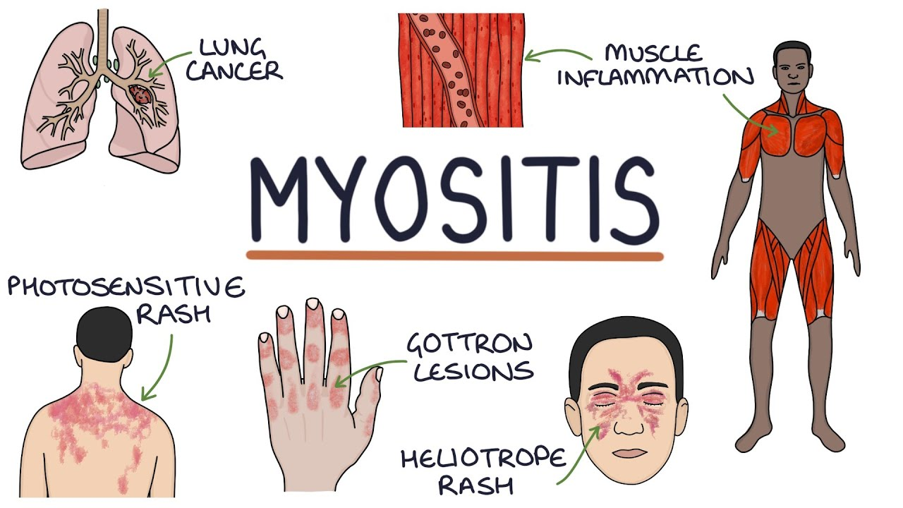 8.7 Idiopathic Inflammatory Myopathy (IIMs): Dermatomyositis (DM), Polymyositis (PM)

- Prevalence: IIMs are rare, with an estimated prevalence of about 1 in 100,000 people.

- Quality of Life: Patients experience muscle weakness, skin rashes (in dermatomyositis), and systemic symptoms, severely affecting daily activities.

- Mortality: IIMs are associated with increased mortality, especially when complicated by interstitial lung disease or malignancies.