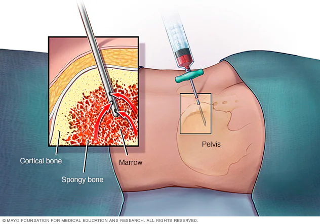 Bone Marrow Aspiration: The procedure involves extracting bone marrow from the hip bone (iliac crest) under local or general anesthesia. The collected bone marrow contains HSCs and MSCs.