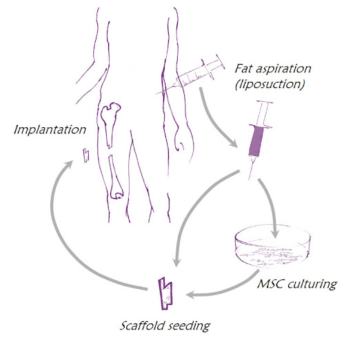  Liposuction: Adipose tissue is collected through a minimally invasive liposuction procedure. The tissue is then processed to isolate and expand MSCs.