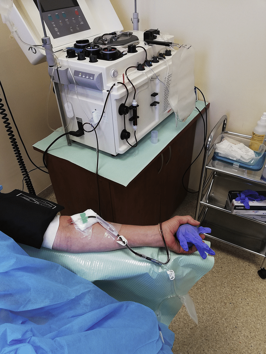 Apheresis: Patients or donors are treated with growth factors (such as granulocyte-colony stimulating factor, G-CSF) to mobilize HSCs from the bone marrow into the peripheral blood. Blood is then collected via apheresis, a process that separates stem cells from other blood components.