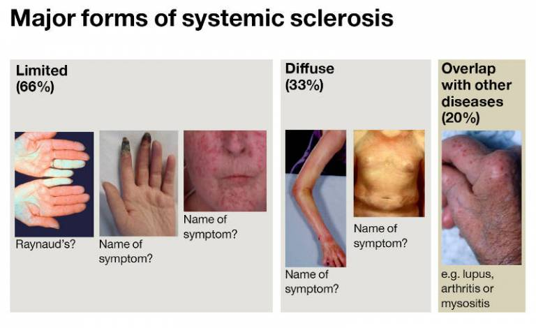 Scleroderma (Systemic Sclerosis)

- Prevalence: Scleroderma (Systemic Sclerosis) affects about 20-50 people per 100,000 globally, with localized scleroderma being more common than systemic scleroderma.

- Quality of Life: Patients experience significant reductions in quality of life due to skin tightening, pain, and organ involvement.

- Mortality: Systemic scleroderma is associated with a high mortality rate, with a 5-year survival rate of approximately 80%.