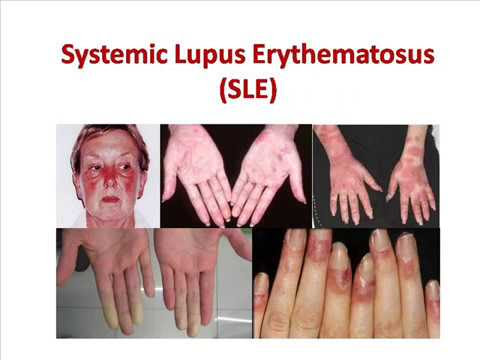 Systemic Lupus Erythematous (SLE)

- Prevalence: SLE affects approximately 20-70 people per 100,000 globally, with significant regional variations.

- Gender Disparity: Women are up to 9 times more likely to develop SLE than men.

- Mortality: SLE patients have a standardized mortality ratio (SMR) approximately 2-3 times higher than that of the general population, largely due to complications like cardiovascular diseases and infections.