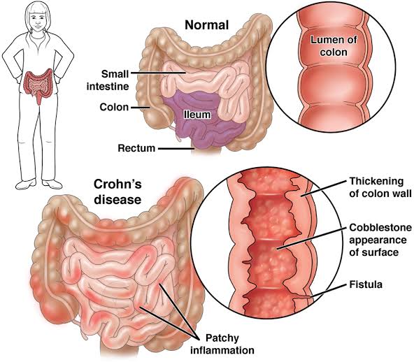 Crohn's disease, a form of inflammatory bowel disease (IBD), afflicts millions worldwide, with incidence rates varying geographically.