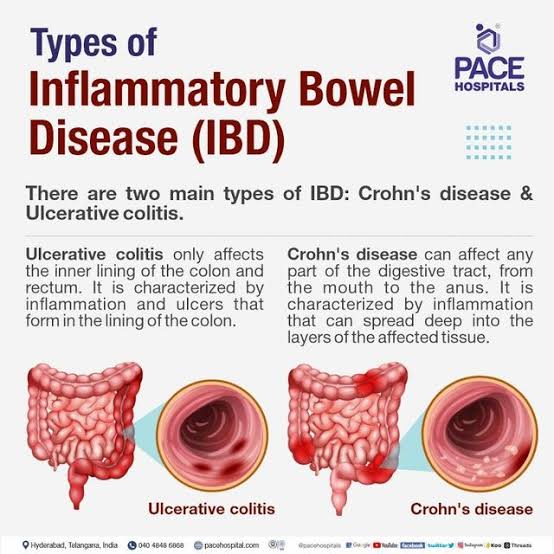 Inflammatory bowel disease (IBD), including both Crohn's disease and ulcerative colitis, affects millions globally, with rising incidence observed in many regions.