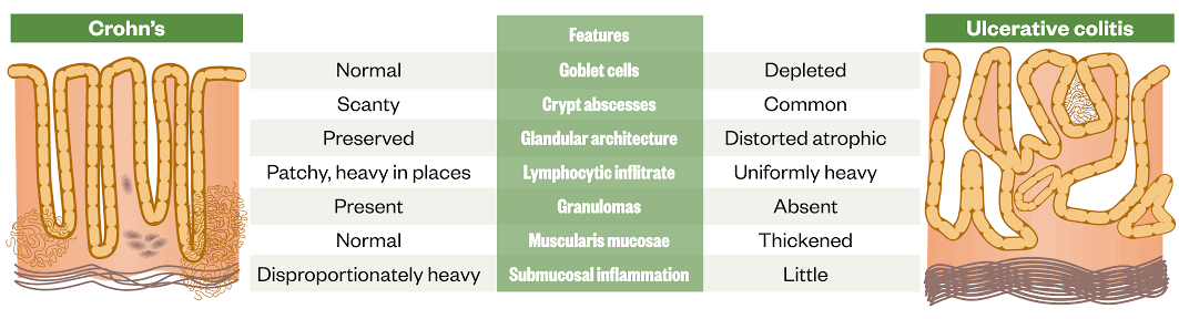 Histological Evaluation: Improvement after our Cellular Therapy and Stem Cells for Digestive Tract Diseases are demonstrated by regression or stabilization of mucosal inflammation and disease activity on follow-up biopsy samples.