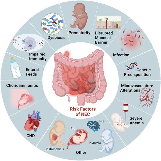 Necrotizing Enterocolitis (NEC):
Fecal occult blood test

- Fecal calprotectin

- Markers of inflammation (CRP, interleukins)

- Imaging studies (abdominal X-ray, ultrasound)

- Assessment of abdominal tenderness and distension