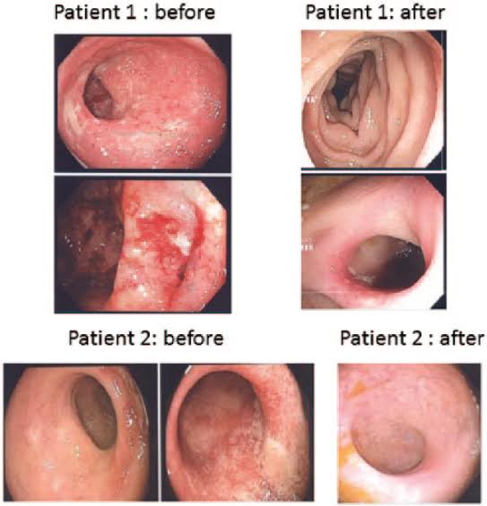 Here is a colonoscopy pictures of patients with Crohn’s disease and ulcerative colitis (UC) demonstrating improvement after receiving our special treatment protocols or cellular therapy and various ESIC progenitor stem cells (PSCs) before and after, approximately 6 months apart