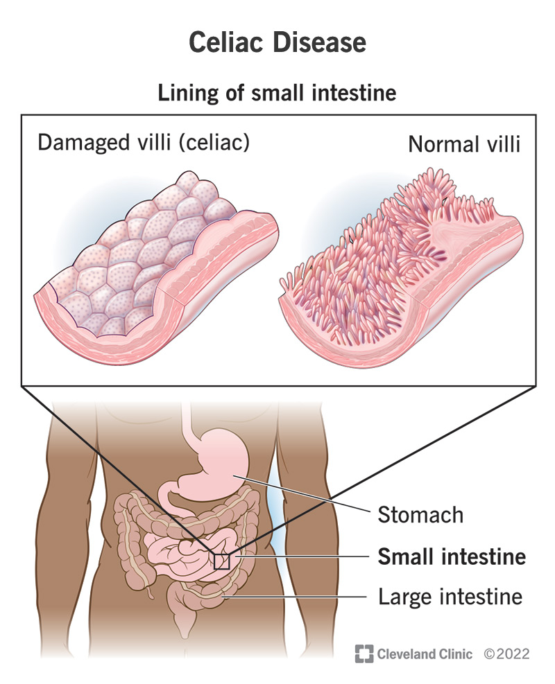 Untreated celiac disease can lead to malabsorption, nutrient deficiencies, and long-term complications such as osteoporosis and gastrointestinal cancers.