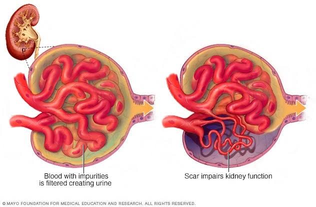 Familial Focal Segmental Glomerulosclerosis (fFSGS):

- fFSGS, though relatively rare, poses a considerable health threat, particularly in familial clusters.

- Genetic predispositions contribute to its pathogenesis, necessitating specialized diagnostic and therapeutic approaches.