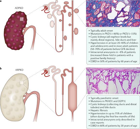 Polycystic Kidney Disease (PKD):

- PKD affects approximately 1 in 500 to 1,000 individuals worldwide, making it one of the most prevalent genetic kidney disorders.

- It carries a substantial risk of renal failure, necessitating vigilant monitoring and early intervention strategies.