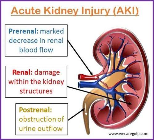 Acute Kidney Injury (AKI):

- AKI accounts for over 13 million cases annually worldwide, with mortality rates reaching as high as 20-30% in severe cases.

- Various factors, including sepsis, nephrotoxic medications, and surgical complications, contribute to its multifaceted etiology.