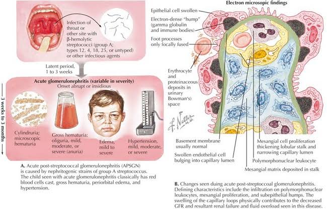 Glomerulonephritis (GN):

- GN encompasses a spectrum of inflammatory renal disorders, affecting millions globally and posing significant diagnostic and therapeutic challenges.

- Immunological dysregulation underlies many forms of GN, necessitating tailored immunosuppressive therapies.