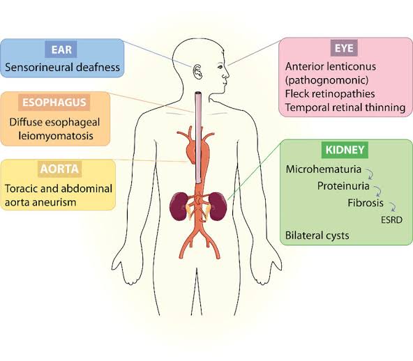 Alport Syndrome (AS):

- AS, though relatively rare, carries substantial morbidity and mortality risks, particularly in affected males.

- Renal manifestations often manifest in childhood, progressing to end-stage renal disease in a significant proportion of patients.