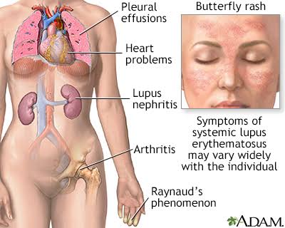 Lupus Nephritis (LN):

- LN complicates approximately 40-60% of systemic lupus erythematosus (SLE) cases, significantly impacting patients' quality of life and prognosis.

- Ethnic and socioeconomic disparities contribute to variability in disease prevalence and outcomes.