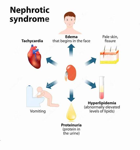 Nephrotic Syndrome (NS):

- NS affects approximately 16 per 100,000 individuals annually, with higher incidence rates observed in children.

- Complications such as thromboembolism and infections pose substantial risks in NS patients, warranting multidisciplinary management approaches.