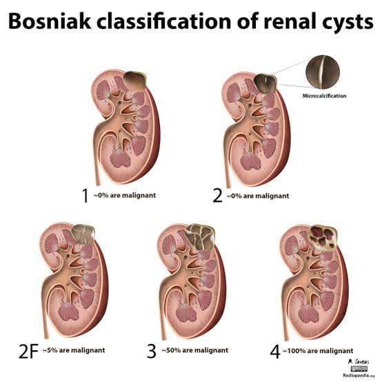 Kidney Cysts:

- Renal cysts, including simple and complex cysts, are prevalent in aging populations, affecting up to 50% of individuals over 50 years old.

- While most cysts are benign, they can lead to complications such as infection, hemorrhage, and renal impairment in some cases.