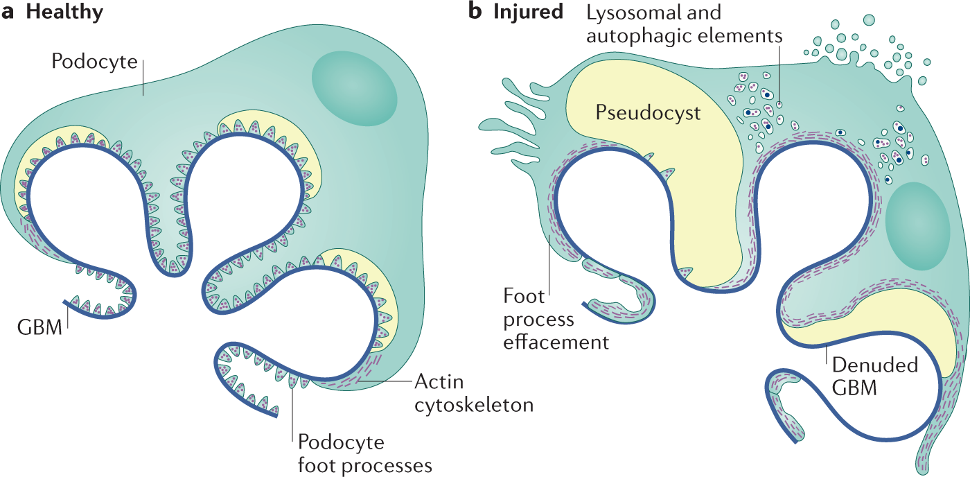 Familial Focal Segmental Glomerulosclerosis (fFSGS):

- fFSGS is a rare genetic disorder characterized by scarring of the glomeruli, leading to proteinuria and kidney dysfunction.

- Research and Clinical Trials into glomerular endothelial progenitor stem cells (GEC-PSCs) and podocyte progenitor stem cells (PC-PSCs) for fFSGS is ongoing, with studies focusing on their potential to repair glomerular damage and restore renal function.

- Preclinical evidence suggests that GEC-PSCs and PC-PSCs may offer promising therapeutic benefits for fFSGS, warranting further investigation in clinical settings.