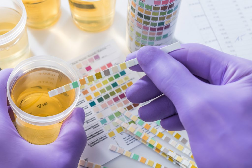 3. Urinalysis: Analysis of urine composition helps in detecting abnormalities such as proteinuria (presence of protein in urine), hematuria (presence of blood in urine), and urinary sediment. These findings aid in diagnosing and monitoring kidney diseases, including glomerulonephritis and diabetic nephropathy. (Urinalysis allows us to assess kidney function and identify signs of inflammation, infection, or damage in the urinary tract.)