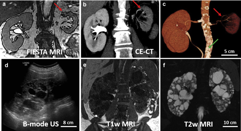 Imaging Studies: Imaging modalities like ultrasound, CT scan, and MRI provide detailed images of the kidneys, allowing visualization of structural abnormalities, such as cysts in polycystic kidney disease (PKD) or renal cysts. These studies also help in evaluating kidney size, shape, and blood flow. (Imaging studies help us visualize the kidneys and identify any structural abnormalities or lesions that may be contributing to the kidney condition.)

Post-treatment imaging studies demonstrate regression or stabilization of structural abnormalities such as cysts in polycystic kidney disease (PKD) or renal cysts. Changes in kidney size, shape, and blood flow may indicate improved renal perfusion and vascular function. These findings reflect positive treatment outcomes and reduced risk of complications associated with structural kidney abnormalities.