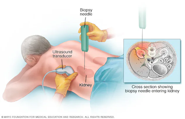 Kidney Biopsy: In cases where the diagnosis remains unclear or to assess the extent of kidney damage, a kidney biopsy may be performed. This procedure involves obtaining a small tissue sample from the kidney for microscopic examination. It helps in confirming the diagnosis and determining the underlying cause of kidney disease, such as glomerulonephritis or lupus nephritis. (A kidney biopsy provides detailed information about the specific type and severity of kidney disease, guiding treatment decisions.)

Improvements following treatment are reflected in kidney biopsy findings, with evidence of decreased inflammation, reduced fibrosis, and restoration of normal tissue architecture. Reductions in glomerular abnormalities such as sclerosis or proliferation indicate improved glomerular function and reduced risk of progressive kidney damage. These improvements signify successful treatment interventions and reduced risk of disease progression.