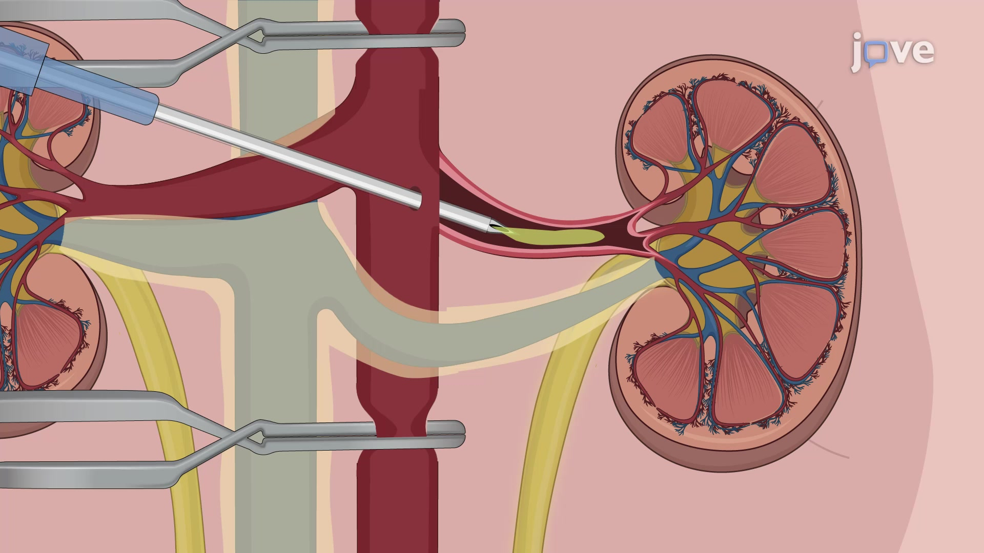 Enhancing Cellular Therapy and Stem Cells for Kidneys and Renal Diseases' Delivery to the Kidney: Innovative Strategies for Targeted Therapy

Continuing our quest for innovation, our team of Cellular Therapy and Stem Cells for Kidneys and Renal Diseases' Researchers persistently explores novel strategies aimed at refining the delivery of stem cells specifically to the kidneys for therapeutic applications. Through ongoing Research and Clinical Trials development efforts, we endeavor to unlock new avenues for improving treatment outcomes and enhancing patient care in the realm of kidney diseases such as Chronic Kidney Diseases (CKD), Diabetic Nephropathy (DN), Familial Focal Segmental Glomerulosclerosis (fFSGS), Polycystic Kidney Disease (PKD), Acute Kidney Injury (AKI) ,Glomerulonephritis (GN), Alport Syndrome (AS), Lupus Nephritis (LN), Nephrotic Syndrome (NS), Kidney Cysts, Renal Ischemia-Reperfusion (IR) Injury, Acute and Chronic Kidney Failure, End-Stage Renal Disease (ESRD), Renal Fibrosis.