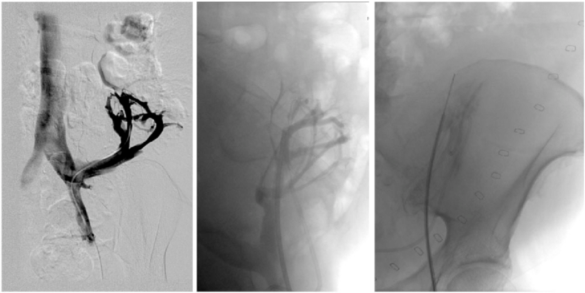 Renal Artery Infusion: Cellular Therapy and Stem Cells for Kidneys and Renal Diseases can be directly infused into the renal artery, allowing for precise delivery to the kidneys. This approach ensures that a high concentration of stem cells reaches the target site, maximizing their therapeutic potential.