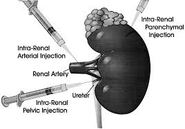 Selective Catheterization: Catheters can be guided to specific renal arteries using fluoroscopic guidance, allowing for selective infusion of Cellular Therapy and Stem Cells for Kidneys and Renal Diseases into the affected kidney or kidneys. This minimally invasive technique reduces the risk of off-target delivery and improves the efficiency of stem cell therapy.