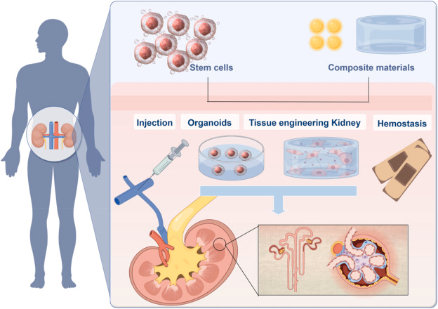 Intrarenal Injection: Cellular Therapy and Stem Cells for Kidneys and Renal Diseases can be injected directly into the renal parenchyma using image-guided techniques such as ultrasound or CT scan. This method enables localized delivery of stem cells to areas of kidney injury or dysfunction, promoting tissue repair and regeneration.