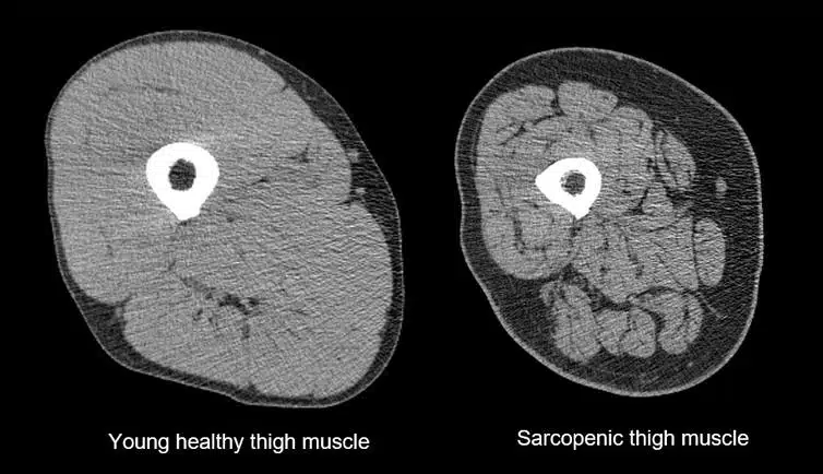 Mitigation of Muscle Wasting (Sarcopenia)

- Mechanism: CKD and its treatments often lead to muscle wasting (sarcopenia). Physical therapy, including resistance training, helps in maintaining and building muscle mass.

- Evidence: Resistance exercise has been shown to increase muscle strength and mass in CKD patients, which is vital for maintaining functional independence .

- Benefit: Preventing sarcopenia improves mobility, reduces the risk of falls and fractures, and enhances the overall physical and mental well-being of patients.