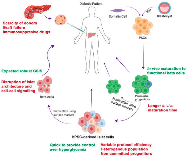 Cellular Therapy and Stem Cells for Pancreatic Diseases utilizing PIBC-PSCs demonstrate exceptional regenerative capacities vital for restoring damaged pancreatic tissues. They play a pivotal role in preserving pancreatic homeostasis and orchestrating tissue repair mechanisms post-injury or disease such as autoimmune pancreatitis, chronic pancreatitis, congenital pancreatic disorders (annular pancreas, pancreatic agenesis), cystic fibrosis-related diabetes (CFRD), diabetes type I and type II, exocrine pancreatic insufficiency (EPI), pancreatic neuroendocrine tumors (PNETs), post-surgical or traumatic pancreatic injury, pancreatic cancer.