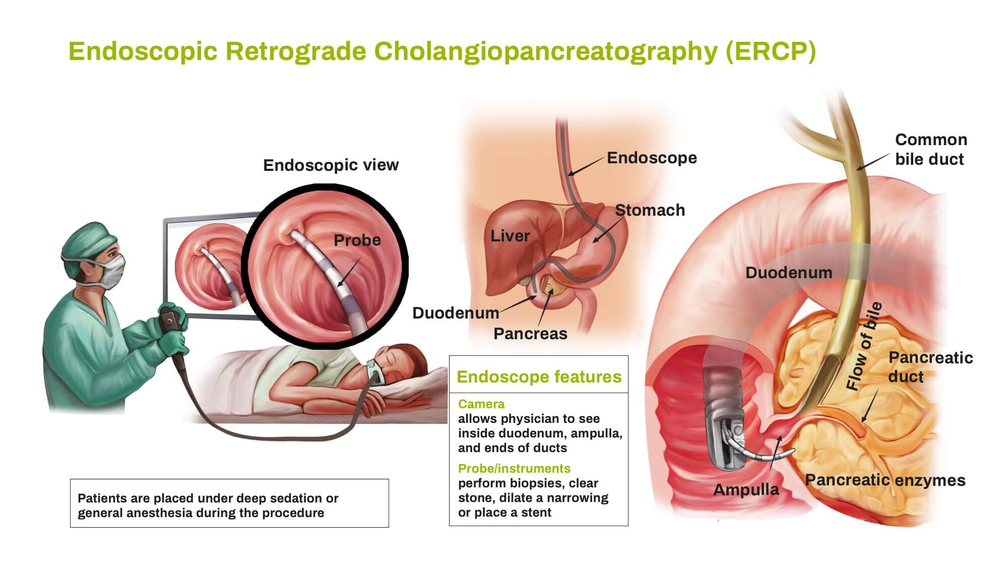 Endoscopic Procedures: In cases where detailed visualization or tissue sampling is required, our team performs endoscopic procedures such as endoscopic ultrasound (EUS) and endoscopic biopsy. EUS allows for high-resolution imaging of the pancreas and adjacent structures, while endoscopic biopsy enables the collection of tissue samples for histological analysis. (Endoscopic procedures provide direct visualization of the pancreas and facilitate tissue sampling for accurate diagnosis of pancreatic disorders such as autoimmune pancreatitis, chronic pancreatitis, congenital pancreatic disorders (annular pancreas, pancreatic agenesis), cystic fibrosis-related diabetes (CFRD), diabetes type I and type II, exocrine pancreatic insufficiency (EPI), pancreatic neuroendocrine tumors (PNETs),post-surgical or traumatic pancreatic injury, pancreatic cancer.)