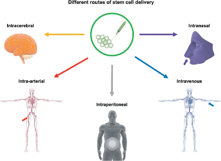 techniques been devised to enhance the transport of Cellular Therapy and Stem Cells for Pancreatic Diseases specifically to the pancreas at our DrStemCellsThailand's Anti-Aging and Regenerative Medicine Center of Thailand