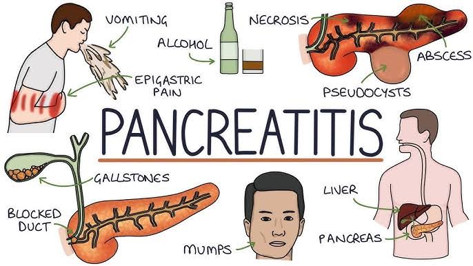 - Chronic Pancreatitis:

- Afflicting an estimated 5 to 12 individuals per 100,000 globally, chronic pancreatitis poses a significant health concern.

- If left untreated, chronic pancreatitis can precipitate severe complications such as malnutrition, diabetes, and even pancreatic cancer.