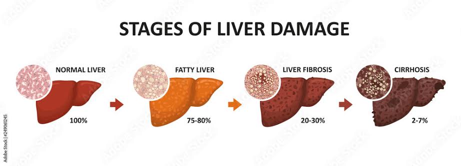 Liver fibrosis can progress to cirrhosis, which significantly increases the risk of liver-related morbidity and mortality. 