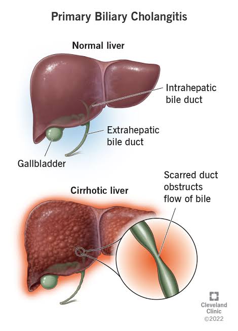 PSC is characterized by chronic inflammation and fibrosis of the bile ducts, leading to progressive liver damage and complications. 