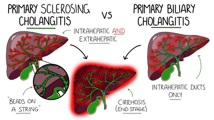 Increased Risk of Cholangiocarcinoma: PSC patients have an elevated risk of developing cholangiocarcinoma (bile duct cancer), which poses diagnostic and therapeutic challenges. 