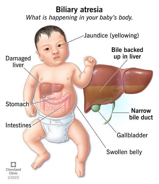 BA often presents with non-specific symptoms, leading to delayed diagnosis and treatment initiation. 