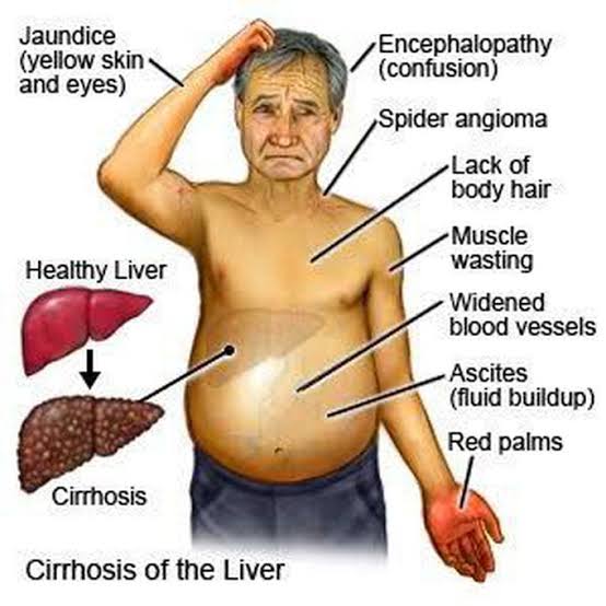 Cirrhosis is often diagnosed at an advanced stage when irreversible liver damage has occurred, leading to complications such as ascites, hepatic encephalopathy, and hepatocellular carcinoma. 